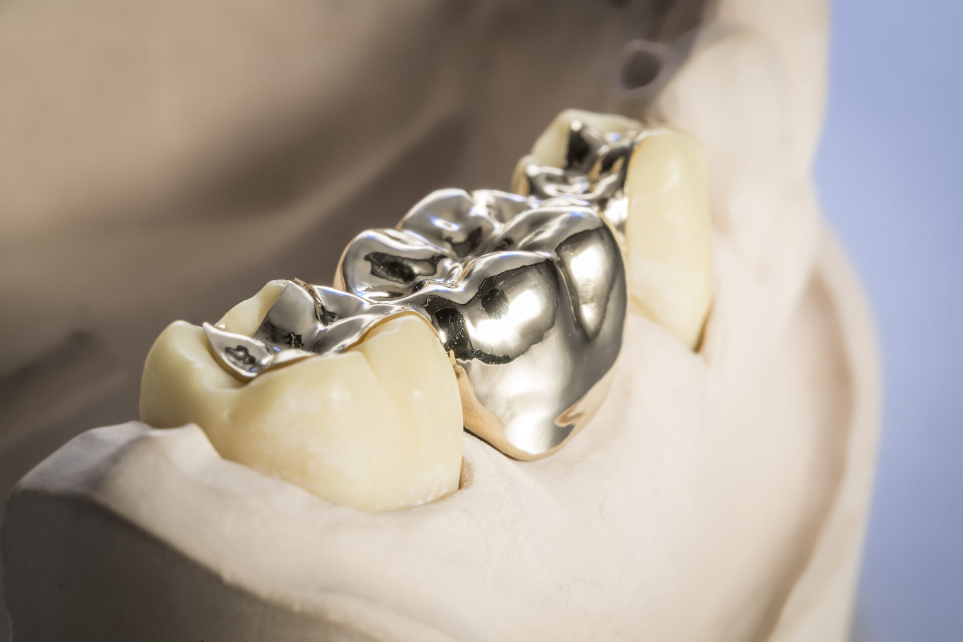 Full Gold Crown Dental