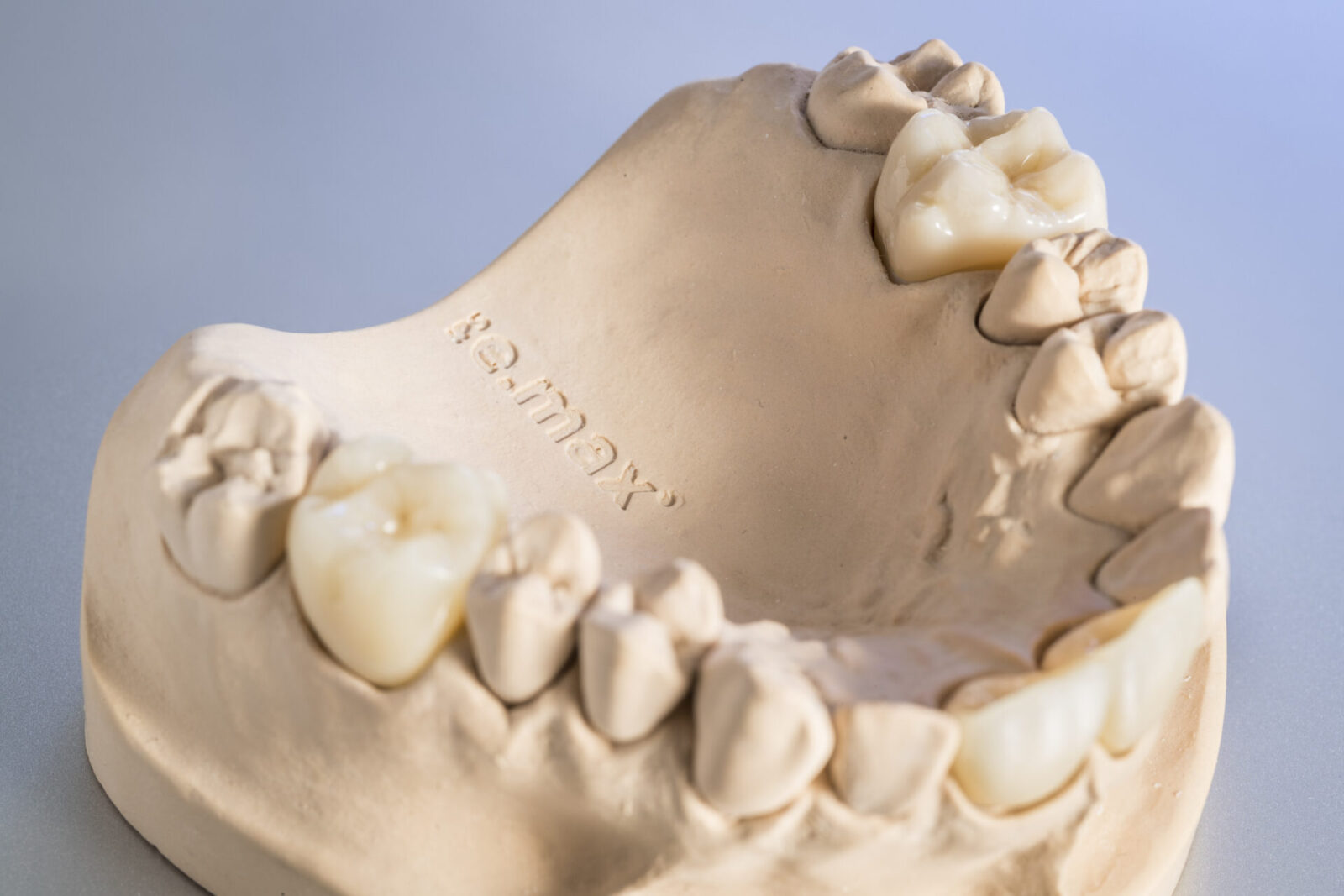 Ips Emax® Ceramic Crowns For A Natural Looking Restoration Precision Dental 6185