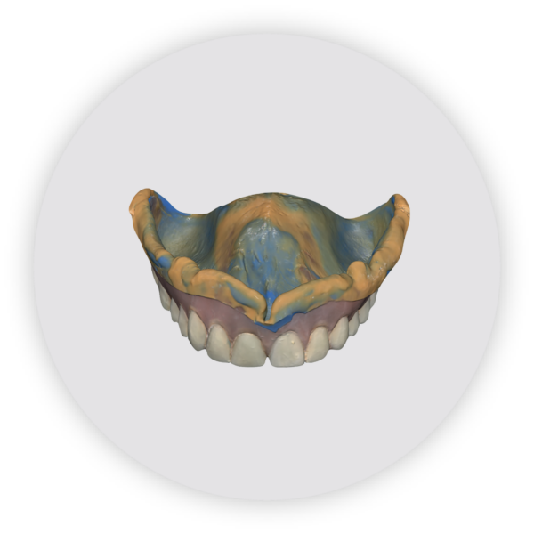 intraoral scan of impression